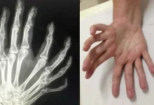 Mirror Hand or Ulnar Dimelia