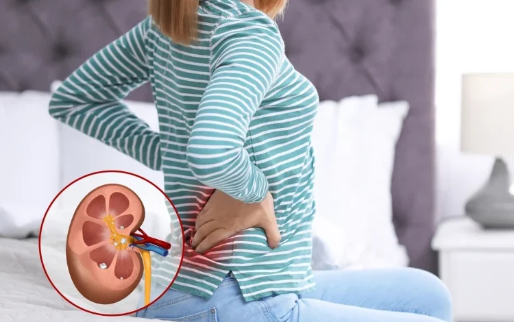 Signs Your Back Pain Might Be a Kidney Stone