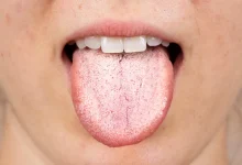 AI Tongue Analysis