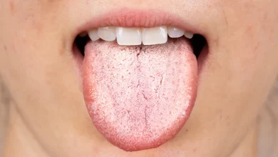 AI Tongue Analysis