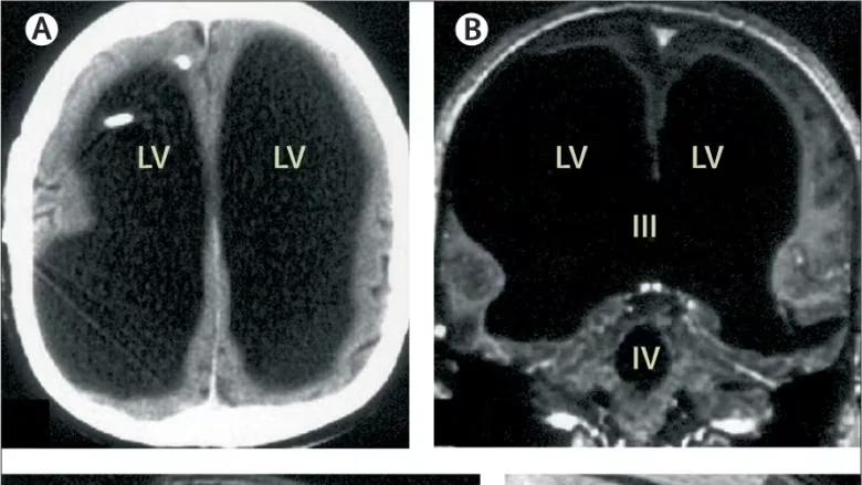 Man with 90% Brain Loss Living a Normal Life