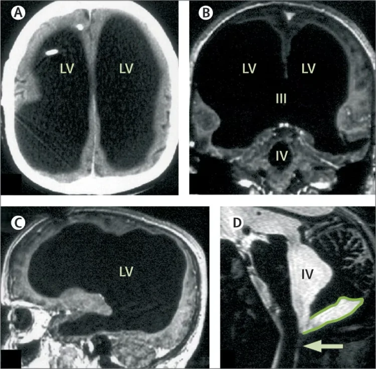 Brain scans from a 2007 study in The Lancet