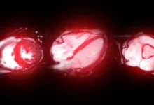 A MRI scan of the heart