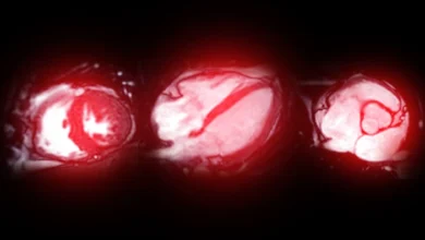 A MRI scan of the heart