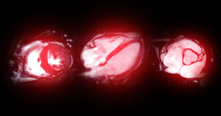 A MRI scan of the heart