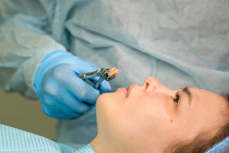 Dentist extracts wisdom tooth Dentist extracts wisdom tooth.