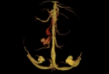Vein of Galen Malformation