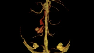 Vein of Galen Malformation
