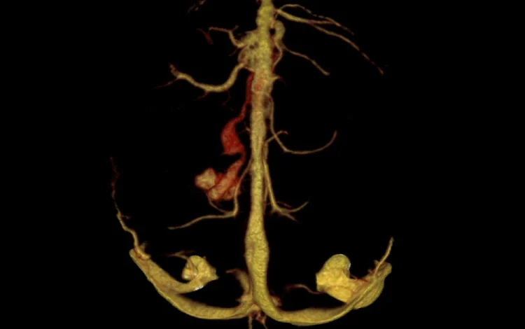 Vein of Galen Malformation