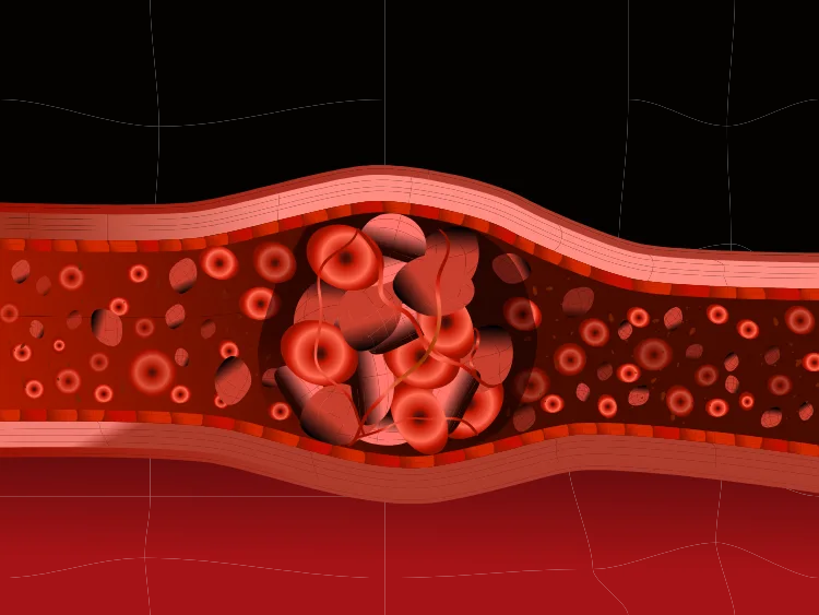 Illustration depicting blood clots blood clot